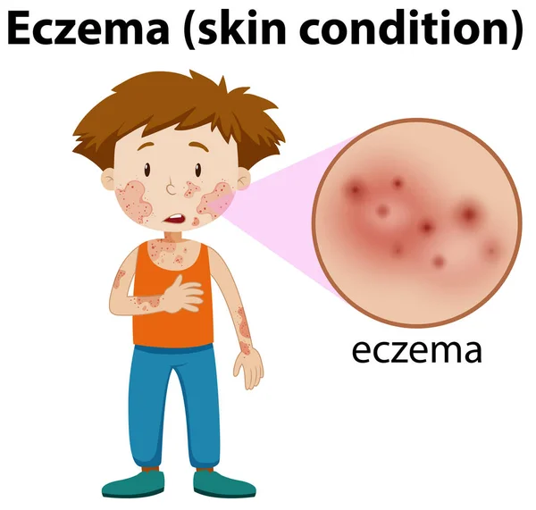 Eczema Magnificado Ilustración Niño — Vector de stock