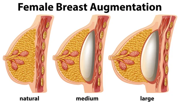 Inställd Kvinnliga Bröstförstoring Illustration — Stock vektor
