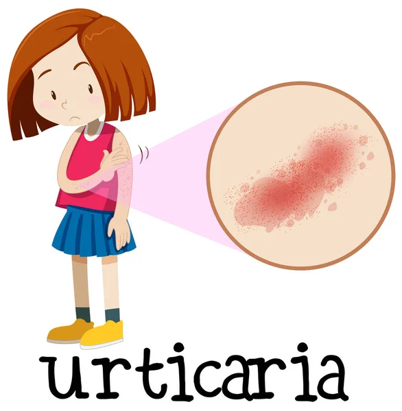 Uma Jovem Garota Com Ilustração Urticária — Vetor de Stock