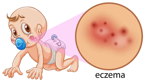 Vector Baby Having Eczema Illustration — Stock Vector