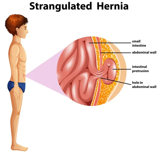 Uma Ilustração Hérnia Estrangulada Anatomia Humana — Vetor de Stock