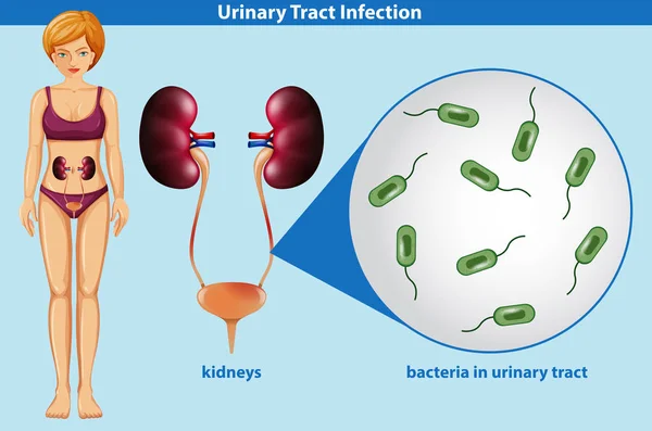 Ilustración Anatomía Humana Infección Del Tracto Urinario — Archivo Imágenes Vectoriales