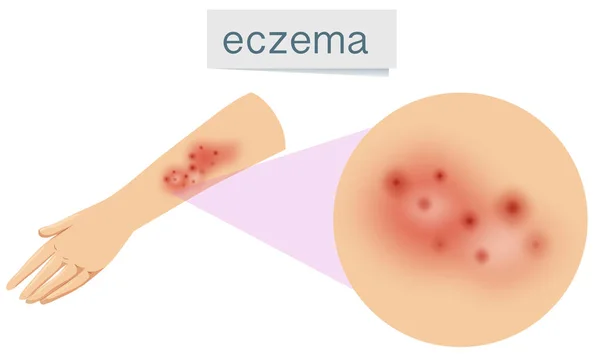 Een Vector Van Eczeem Huid Afbeelding — Stockvector