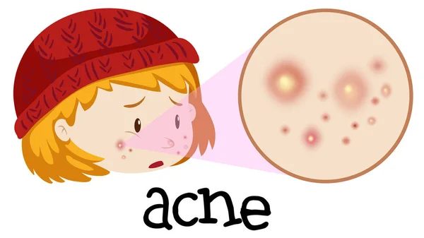 Een Tiener Hebben Acne Het Gezicht Afbeelding — Stockvector