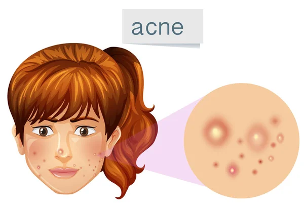 Una Giovane Signora Acne Sul Viso Illustrazione — Vettoriale Stock