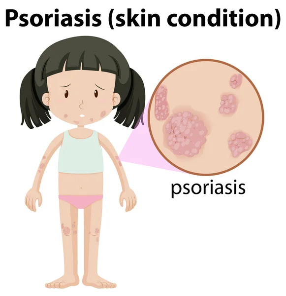 Une Fille Havimg Psoriasis Sur Peau Illustration — Image vectorielle
