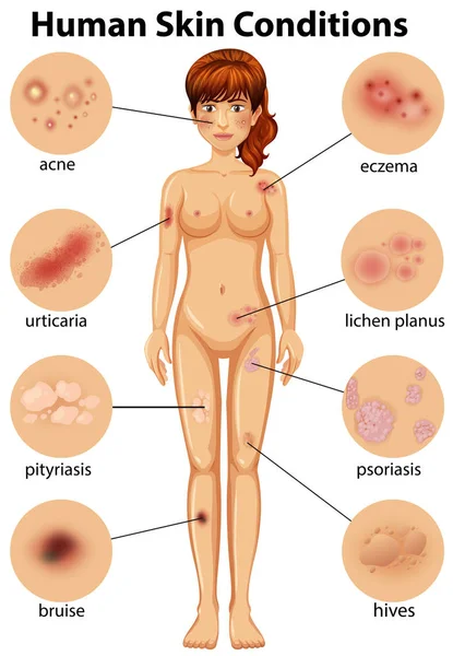 Anatomia Umana Della Condizione Della Pelle Umana Illustrazione — Vettoriale Stock