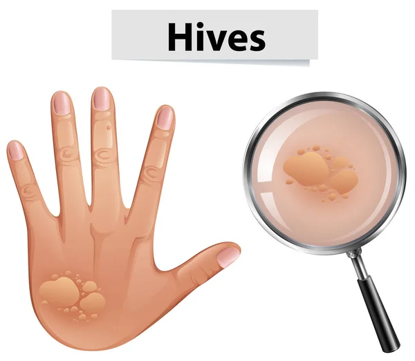 Bir Vektör Hives Illüstrasyon Insan Derisi Üzerinde — Stok Vektör