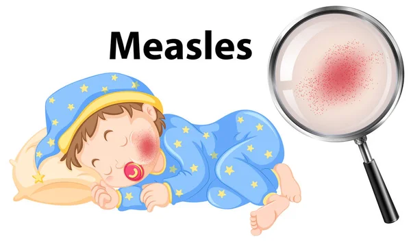 赤ちゃんの顔のイラストを麻疹のベクトル — ストックベクタ