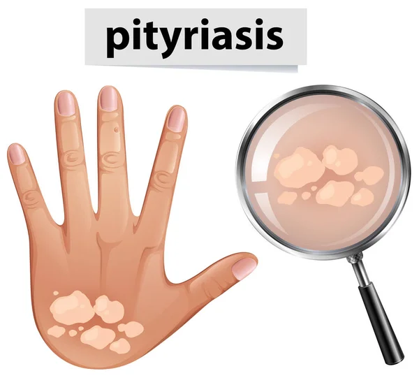 Vettore Pityriasis Sulla Pelle Umana Illustrazione — Vettoriale Stock