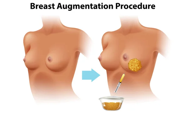 Satu Set Perempuan Breast Augmentation Ilustrasi - Stok Vektor