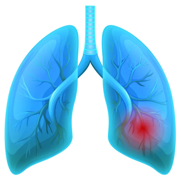 Enfermedad Pulmonar Sobre Fondo Blanco Ilustración — Archivo Imágenes Vectoriales