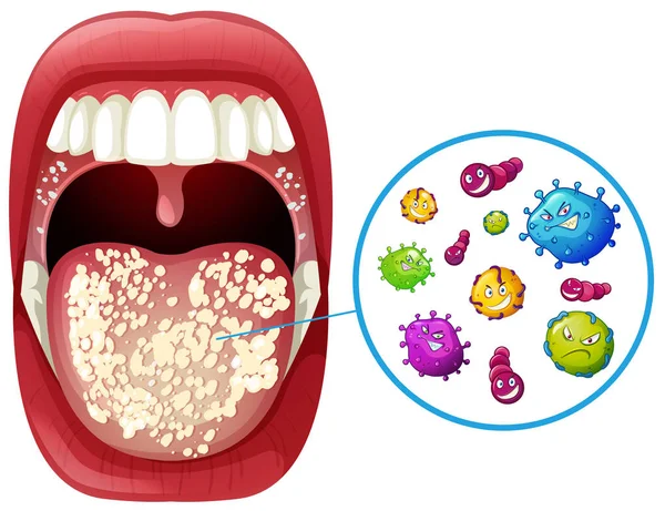 Uma Ilustração Infecção Pelo Vírus Boca Humana — Vetor de Stock