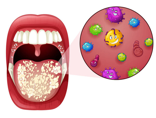 A Human Mouth Virus Infection illustration