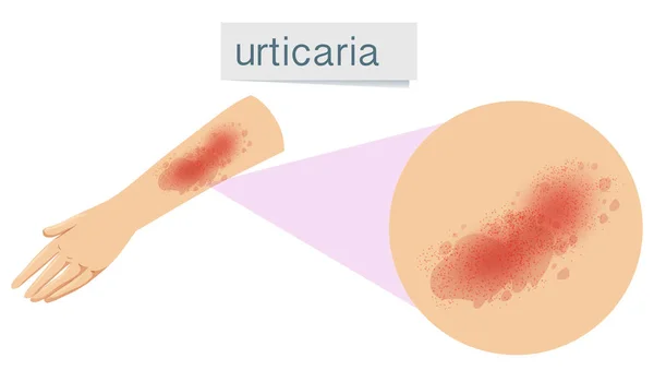 Een Illustratie Van Menselijke Huid Probleem Urticaria — Stockvector