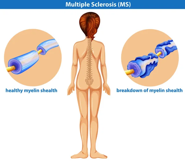 Een Illustratie Van Medische Vector Van Multiple Sclerose — Stockvector