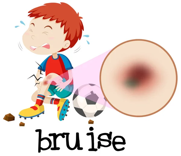 Young Boy Habing Bruise Illustration — Stock Vector