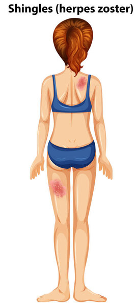 Women with shingles herpes zoster illustration