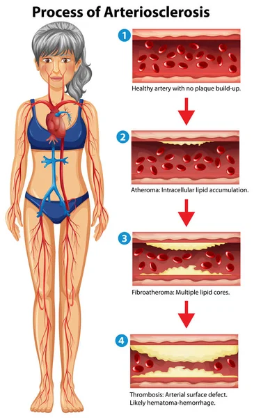 Proceso Arteriosclerosis Ilustración Médica — Vector de stock