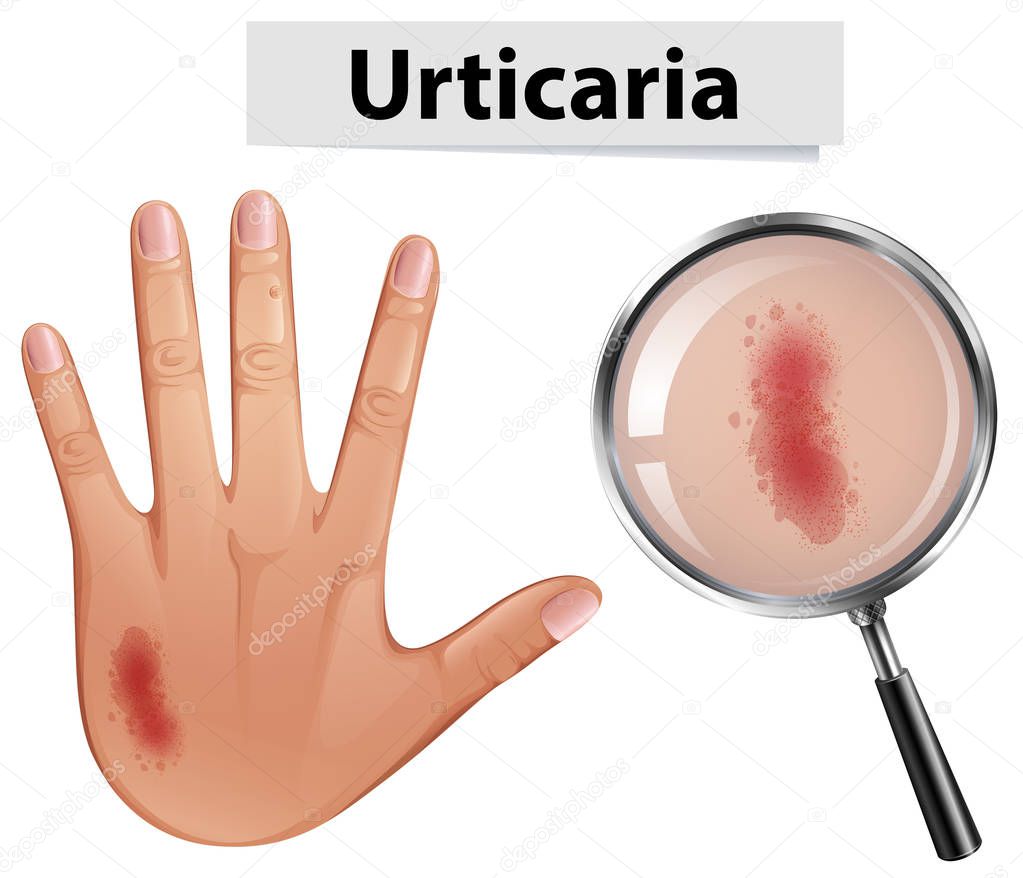 Urticaria magnified on hand illustration