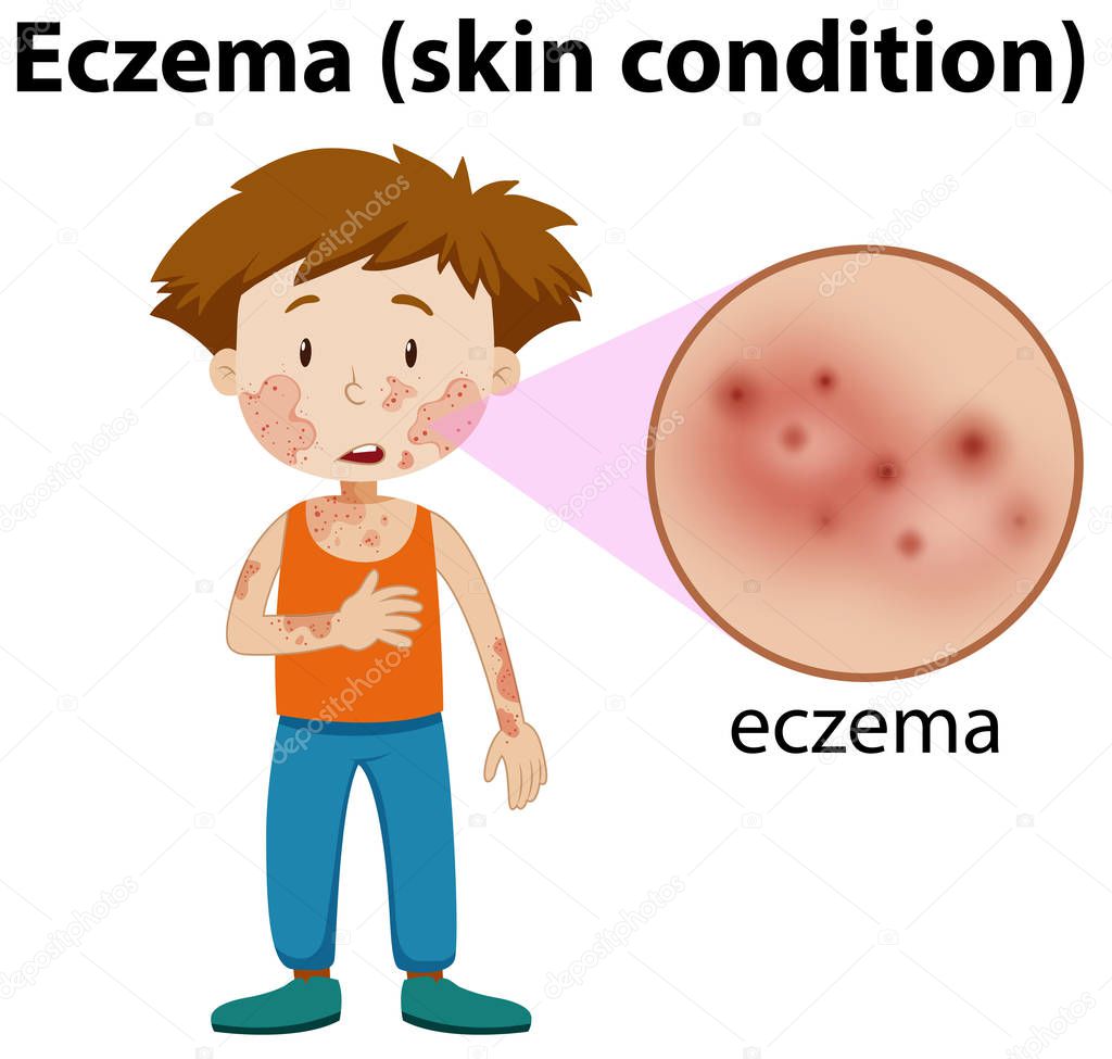 magnified eczema on young boy illustration