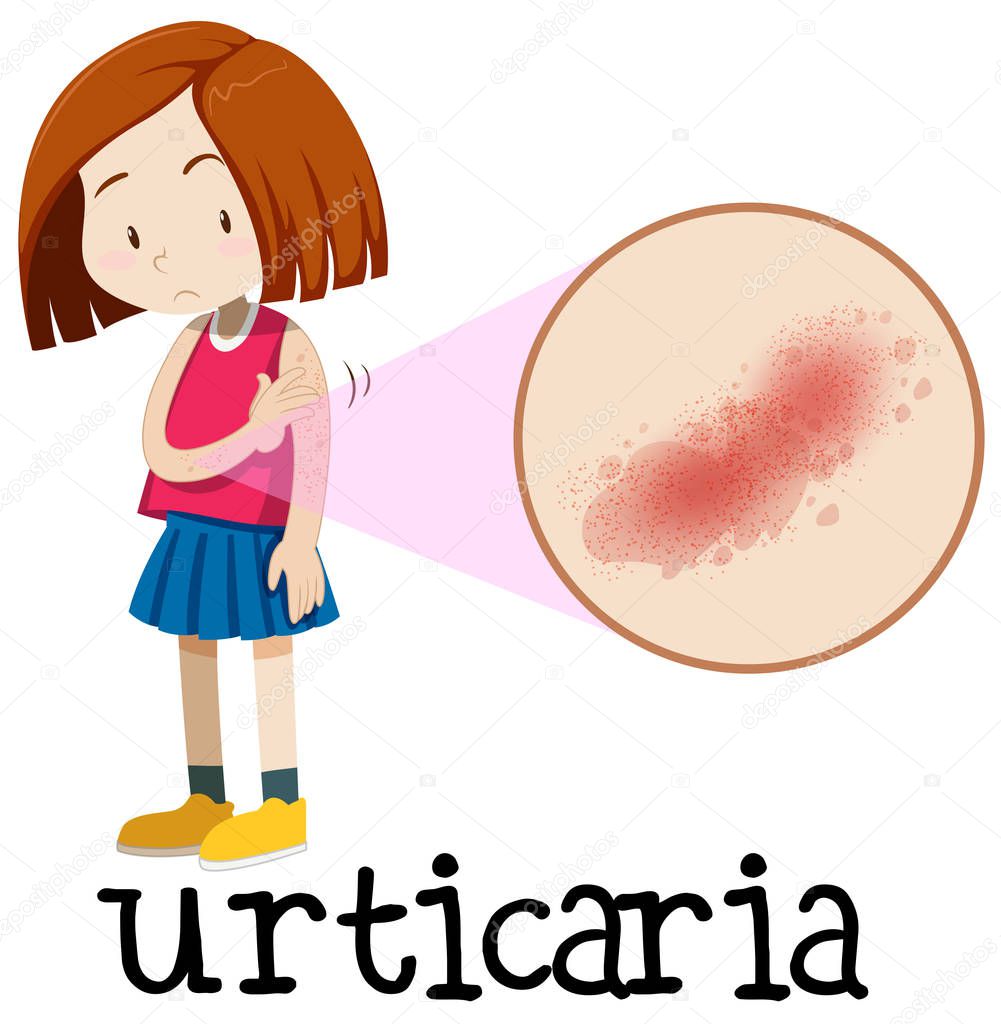 A Young Girl Having Urticaria illustration