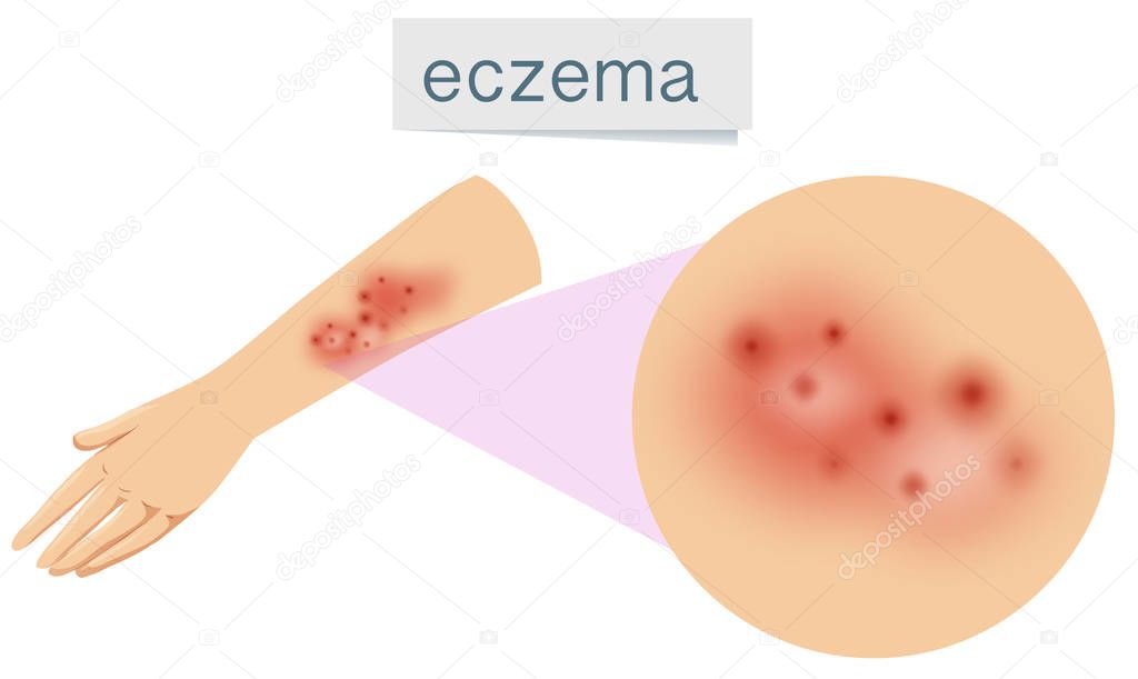 A Vector of Eczema on Skin illustration