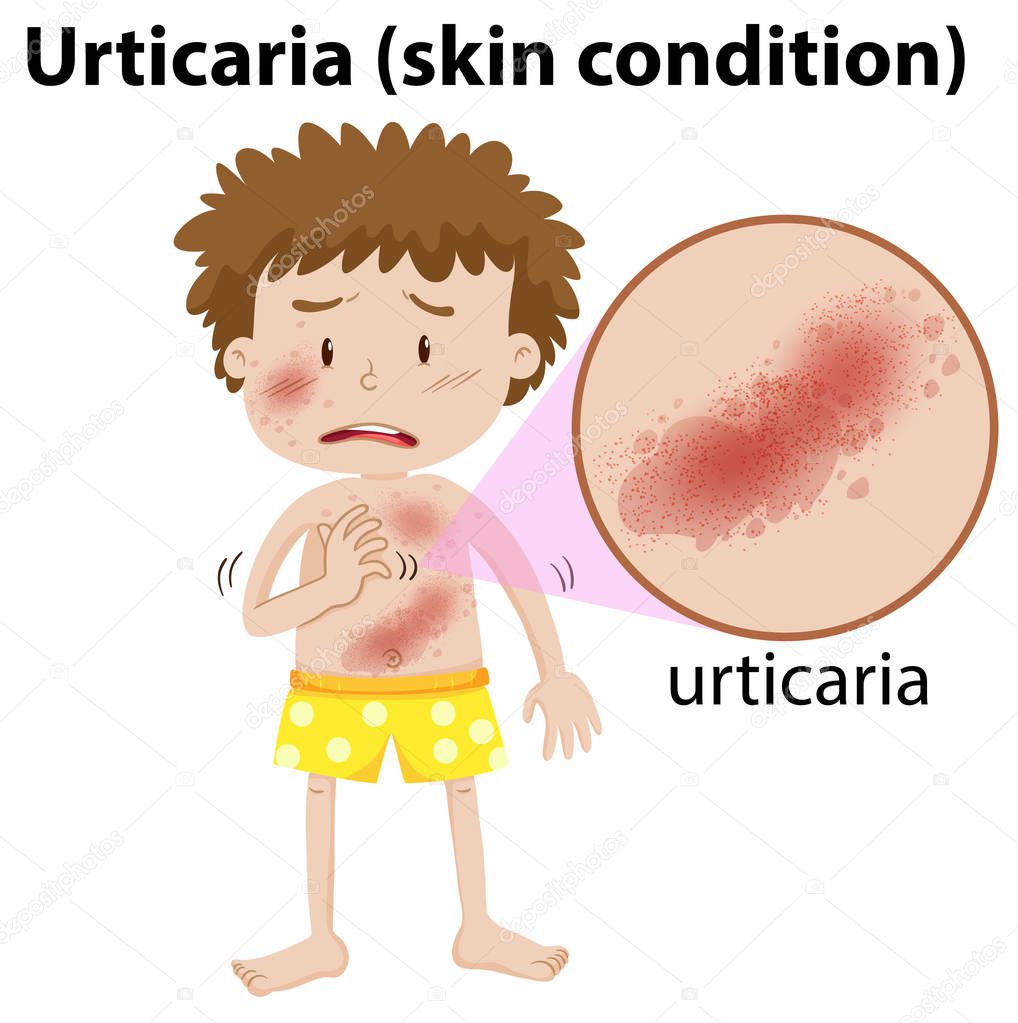 A Young Man Having Urticaria illustration