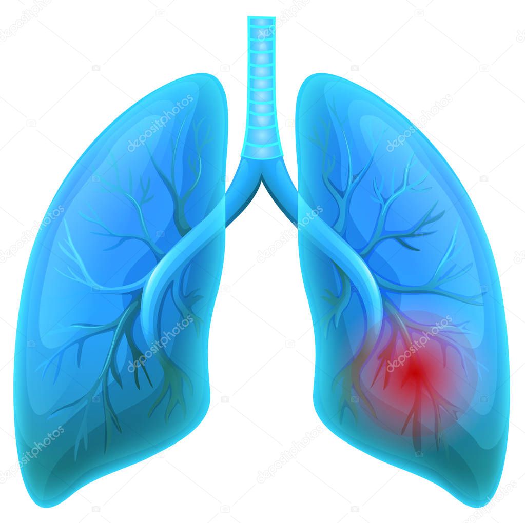 Lung Disease on White Background illustration