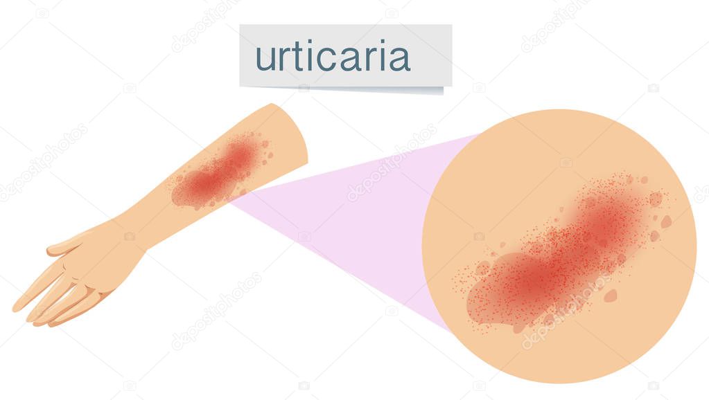 A Human Skin Problem Urticaria illustration