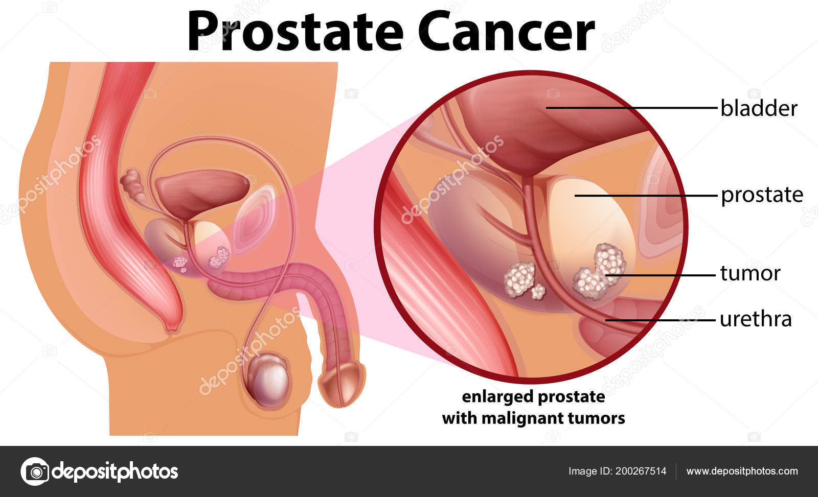 Despre cancerul de prostată