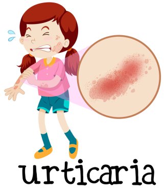 A Girl with Urticaria on White Background illustration clipart