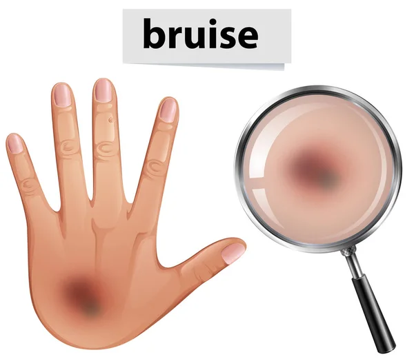 Human Hand Bruise Illustration — Stock Vector