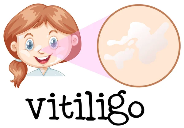 Una Cara Niña Con Ilustración Vitiligo — Archivo Imágenes Vectoriales