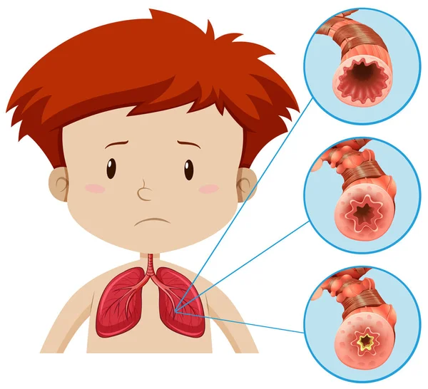 Uma Anatomia Humana Ilustração Problema Pulmonar — Vetor de Stock