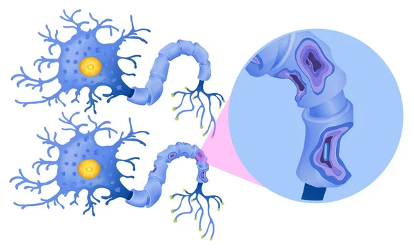 Conjunto Ilustrações Células Nervosas Humanas — Vetor de Stock