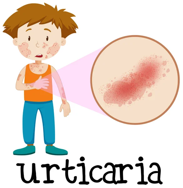 Vector Urticaria Cutánea Ilustración — Vector de stock