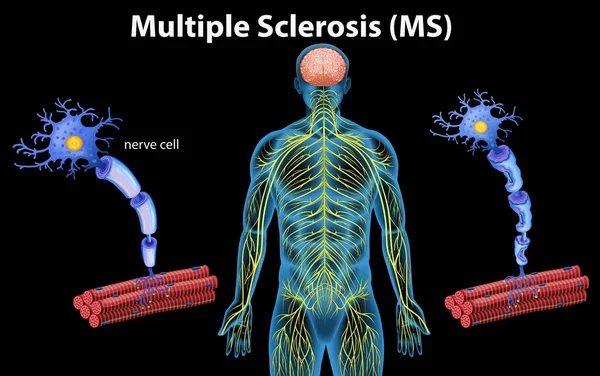Human Anatomy Multiple Sclerosis Illustration — Stock Vector