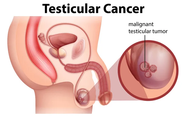 睾丸癌的男性解剖图 — 图库矢量图片