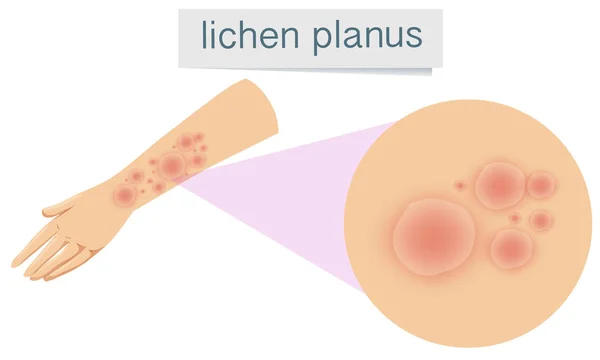 Human Skin Lichen Planus Illustration — Stock Vector