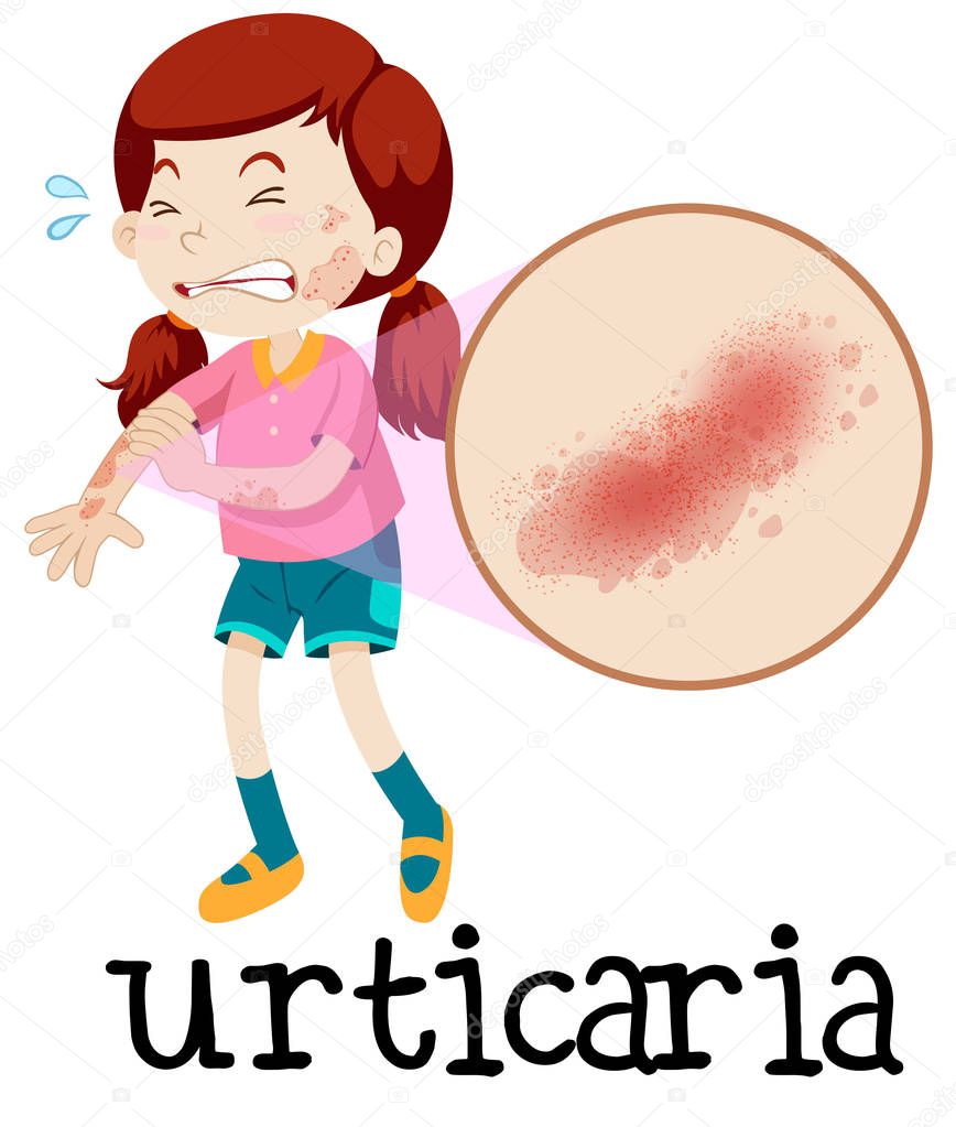 A Girl with Urticaria on White Background illustration