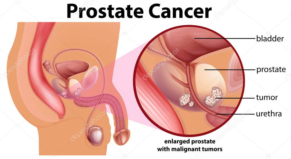 Diagram of prostate cancer illustration