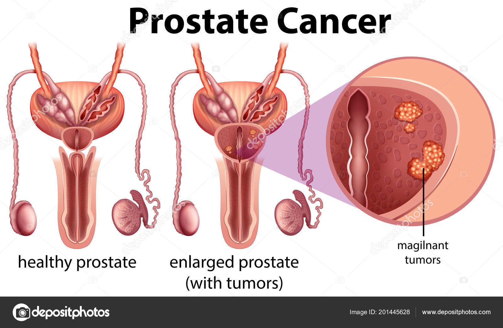 Forum despre Cancerul de prostata | Forumul Medical ROmedic