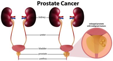 Beyaz arka plan illüstrasyon prostat kanseri