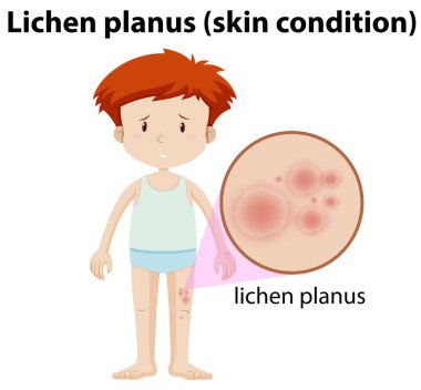 Bir genç adam sahip Lichen Planus illüstrasyon