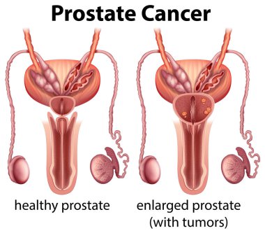 Sağlıklı ve kanser prostat illüstrasyon karşılaştırılması