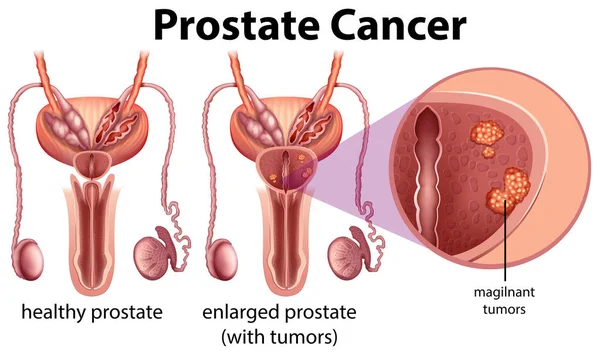 Cancro Alla Prostata Sfondo Bianco Illustrazione — Vettoriale Stock