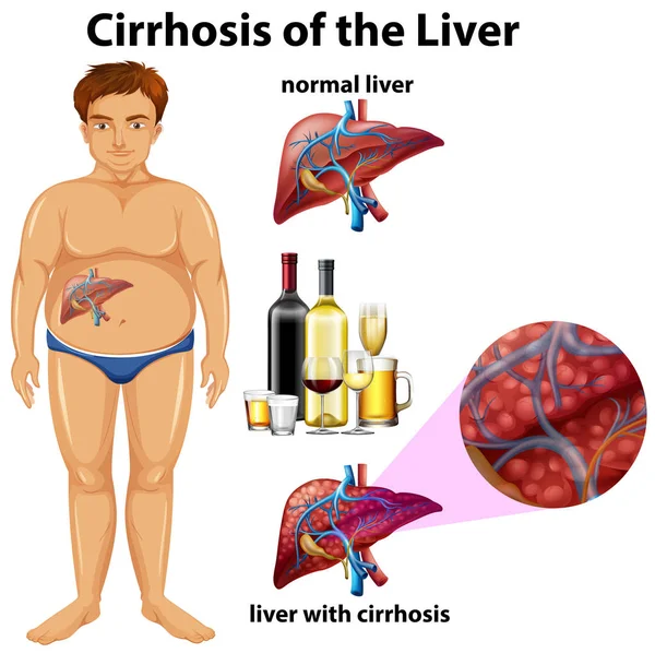 Cirrhosis Levern Illustrationen — Stock vektor