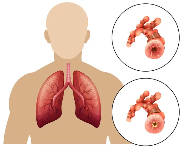 Człowiek Ilustracja Przewlekłej Obturacyjnej Choroby Płuc — Wektor stockowy