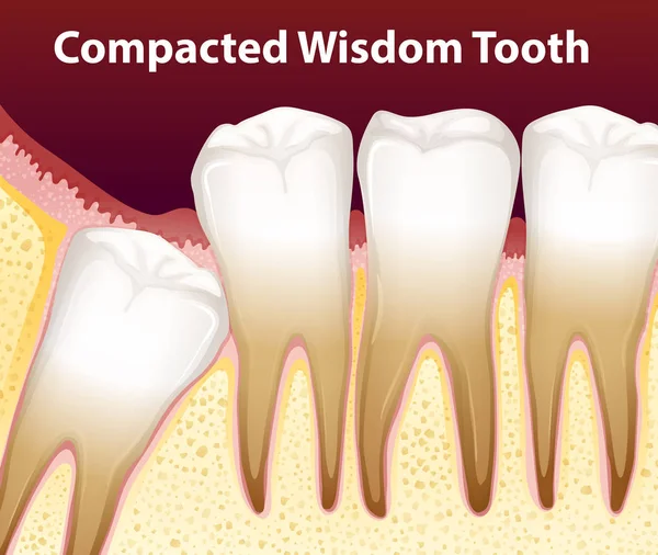 Uma Ilustração Dente Sabedoria Compactada — Vetor de Stock